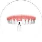 La imagen 1 de la Empresa CLINICA DE IMPLANTES DENTALES DEL SUR Protésico dental en Envigado ANT